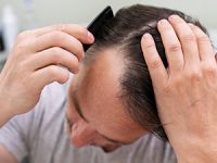 מאיזה גיל גבר יכול לבצע השתלת שיער?